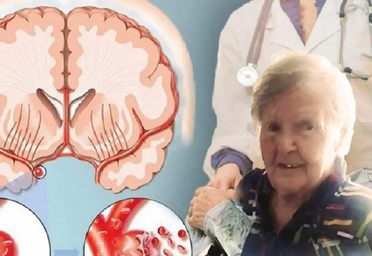 Победа над недугом: врачи спасли 91-летнюю пенсионерку от тяжелого инсульта