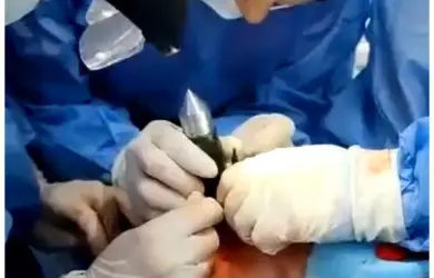 Алматылық офтальмологтар көзіне металл кіріп кеткен ер адамның жанарын сақтап қалды