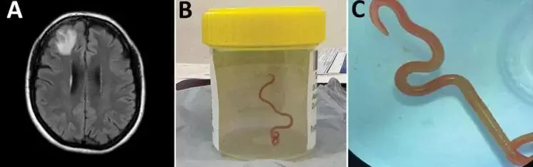 Ученые впервые нашли в мозгу человека живого червя