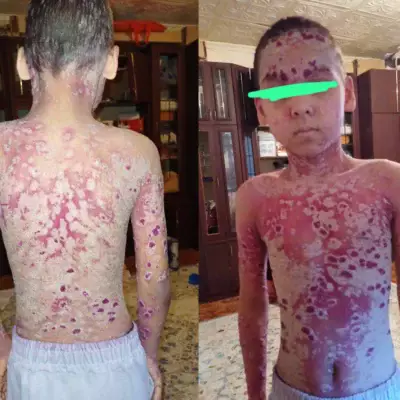 10-летнего мальчика довели до тяжелой формы кожного высыпания в Атырау