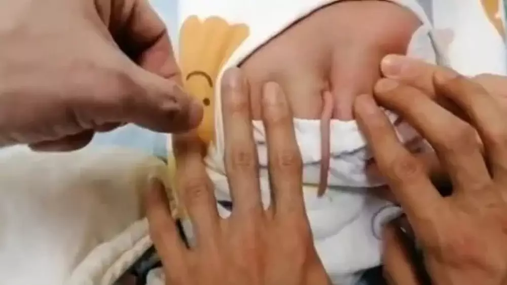 Уникальный ребенок с 10-ти сантиметровым хвостом родился в Китае