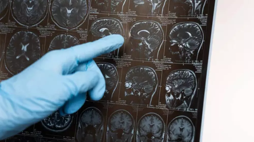 Ученые выяснили, что человеческий мозг вырос за последнее столетие