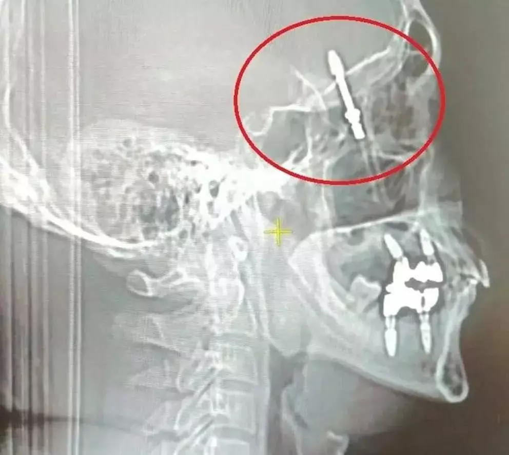 Турецкий стоматолог вкрутил имплант в мозг пациенту