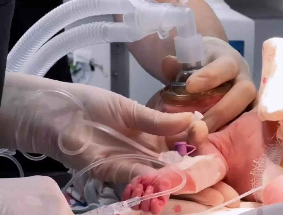 Новорожденного с тяжелым пороком прооперировали врачи в Караганде
