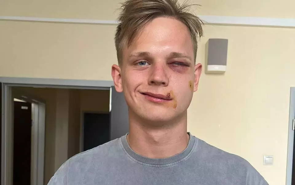 ЦСКА показал, как выглядит лицо Торопа после операции