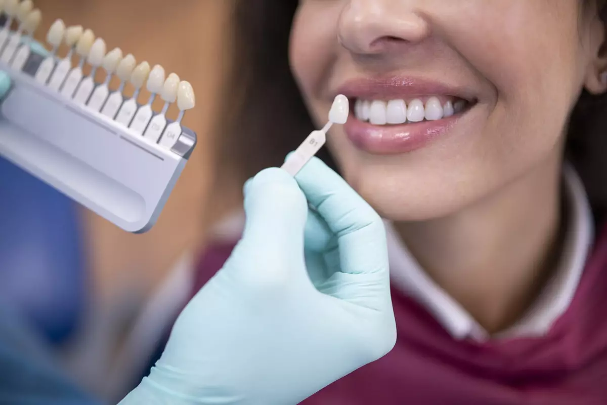 Что такое виниры и сколько они стоят: рассказывает стоматолог