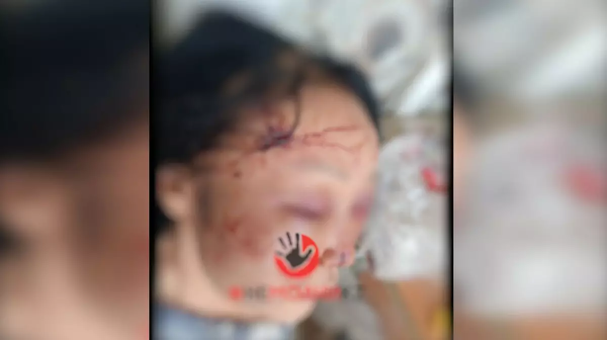 «Насильника даже не задержали»: сестра жестоко избитой женщины жалуется на бездействие полиции
