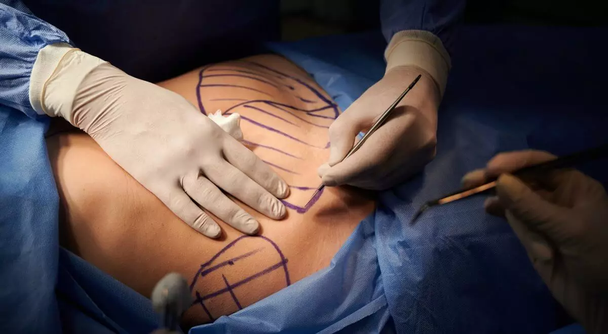 Жуткие шрамы: хирург изуродовал пациентке грудь и живот