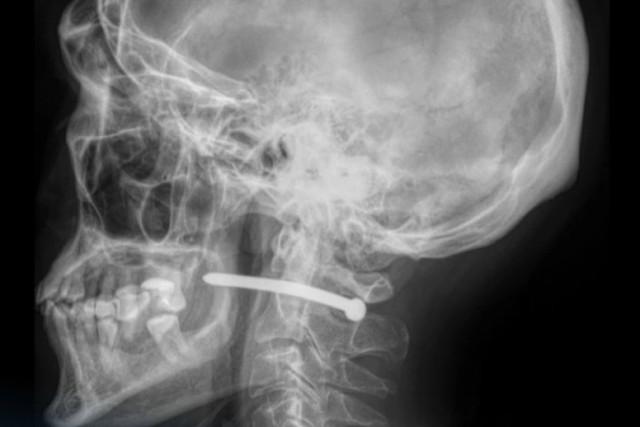 Басына абайсызда шеге атылған ер адам аман қалды