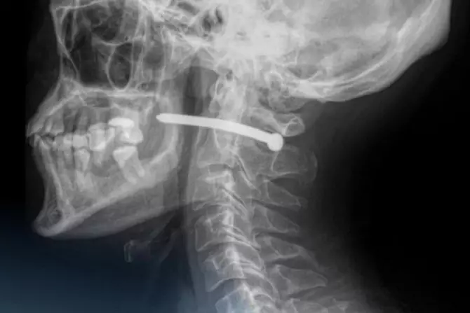 В Казахстане мужчина выжил после того, как выстрелил себе в голову гвоздем.