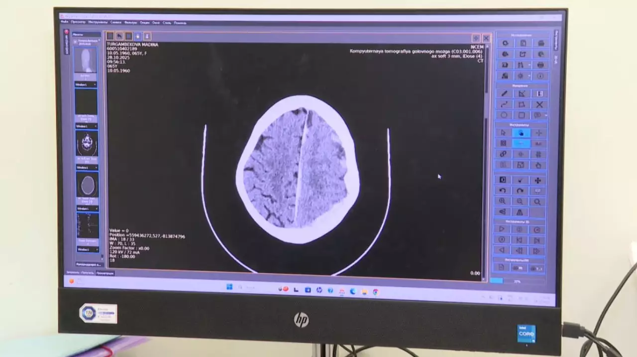Возраст или образ жизни: инсульт стремительно молодеет