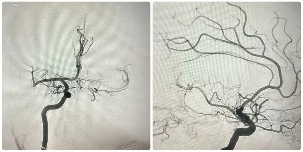 Искусственный интеллект помогает врачам спасать жизни при инсультах