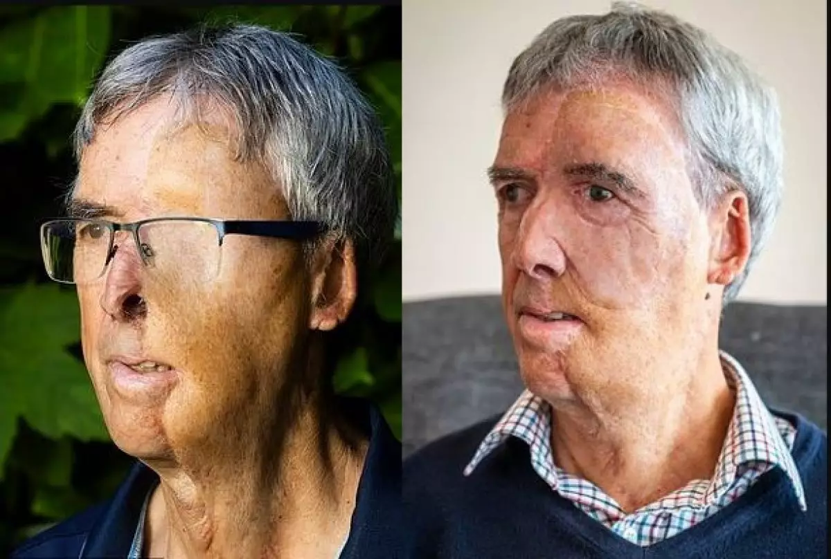 Потерявшему половину лица в ДТП мужчине напечатали протез на 3D-принтере