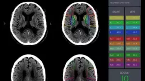 Жасанды интеллект алматылық дәрігерлерге адам өмірін құтқаруға көмектесті