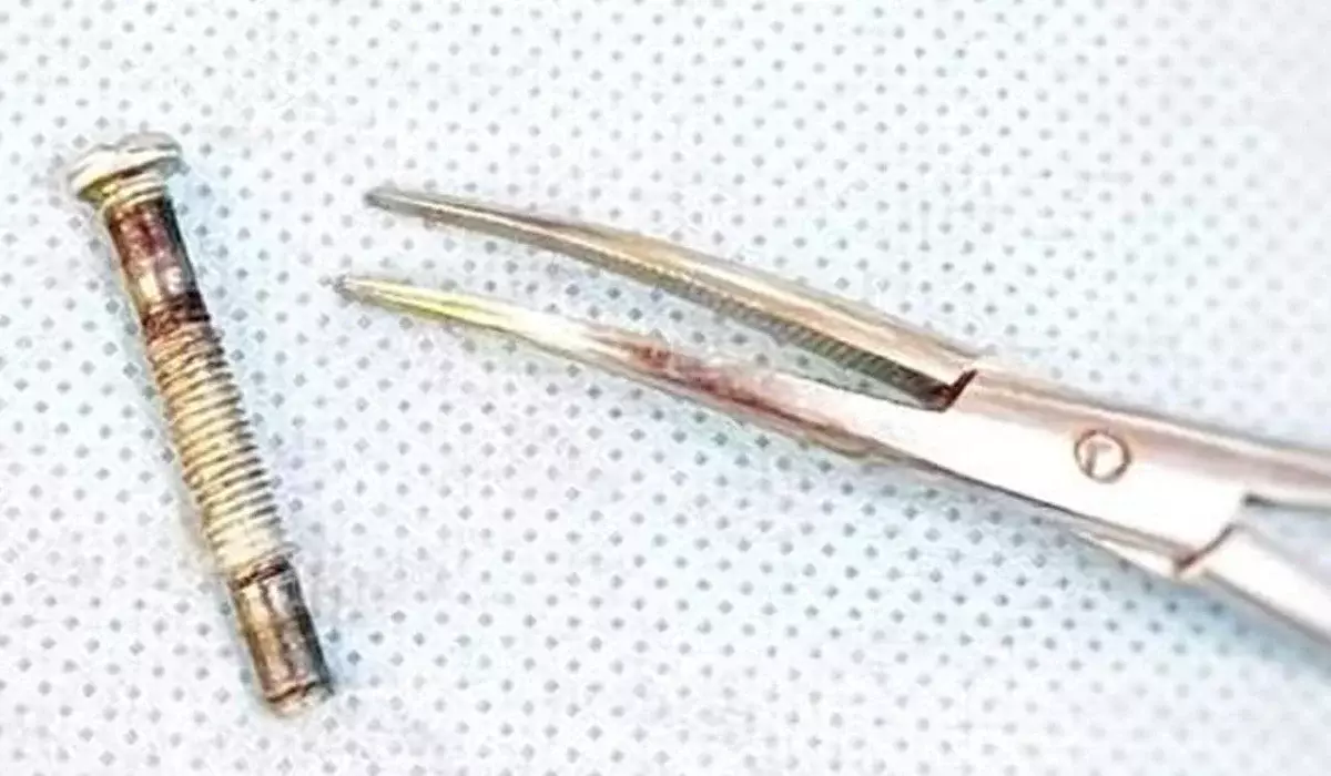 Түркістан облысында бір жасар сәби темір болт жұтып қойған