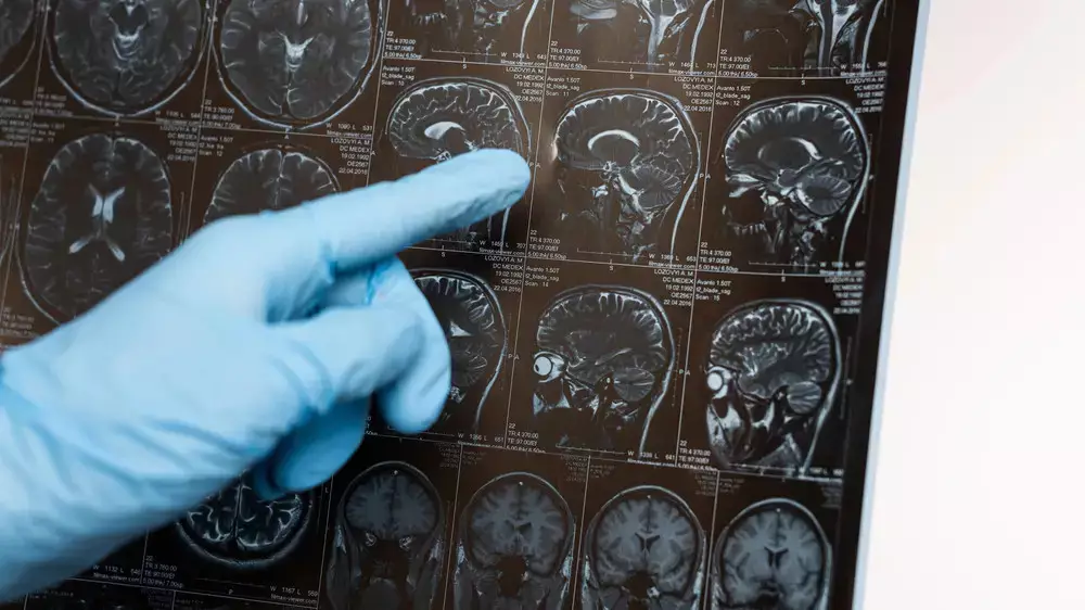 Назван неожиданный фактор, влияющий на развитие деменции