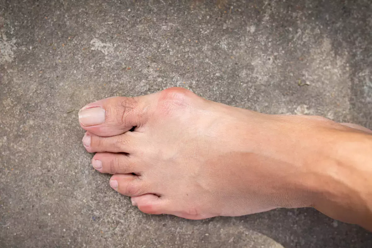 Врач рассказал, что скрывается за безобидной «шишкой» на ноге - новости на Lada.kz 07.11.2025