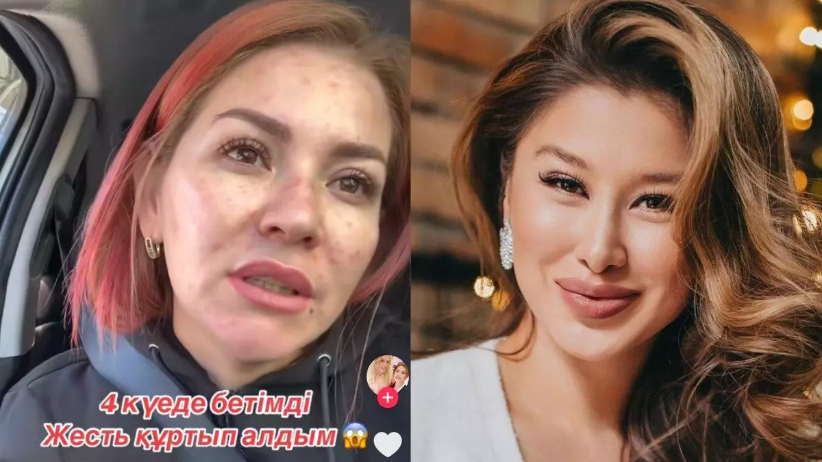 «Қалай емдеймін? Кімге барамын?» Әсел Асқардың жарнамасына еліктеген қыздың беті сұмдық бөртіп кетті