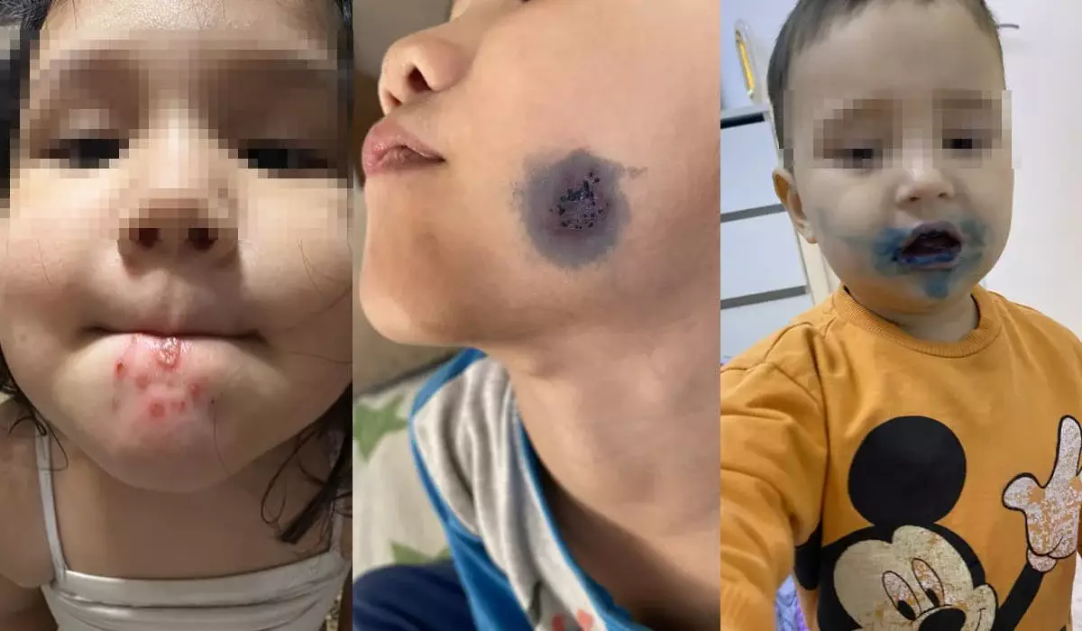 Новый вирус вызывает сыпь у детей? В Минздраве ответили на опасения родителей
