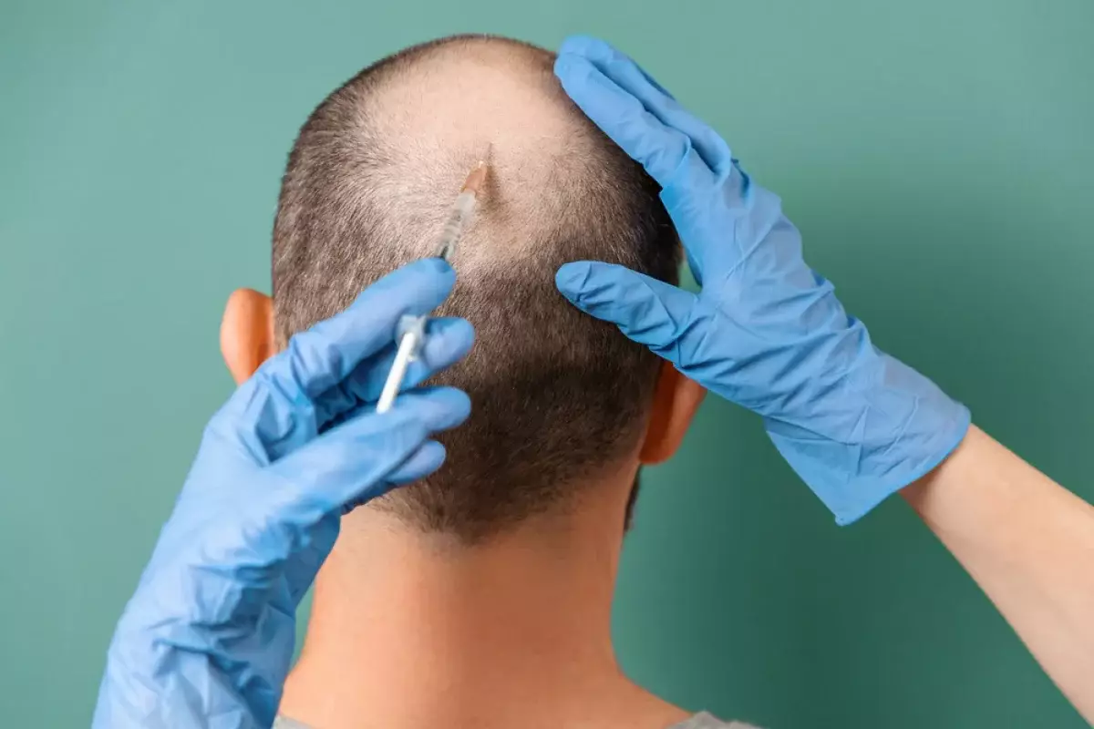 Хотел стать красивее: мужчина скончался после пересадки волос и лечения зубов