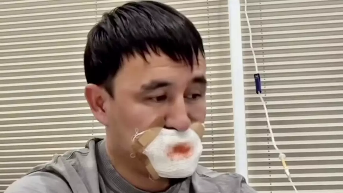 Сүйісу кезінде тілі мен ернін жұлып алған: шулы оқиғаға қатысты тың дерек