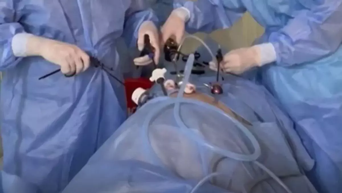 Лапароскопическое ушивание перфоративной язвы: современный подход в экстренной хирургии