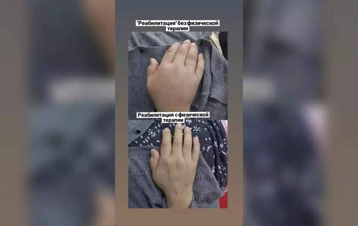 Своевременная реабилитация: как пенсионерка восстановилась после тяжелого инсульта