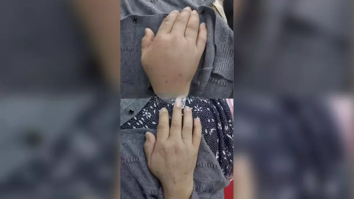 Инсульт алған науқас №7 қалалық ауруханада қалай сауықты