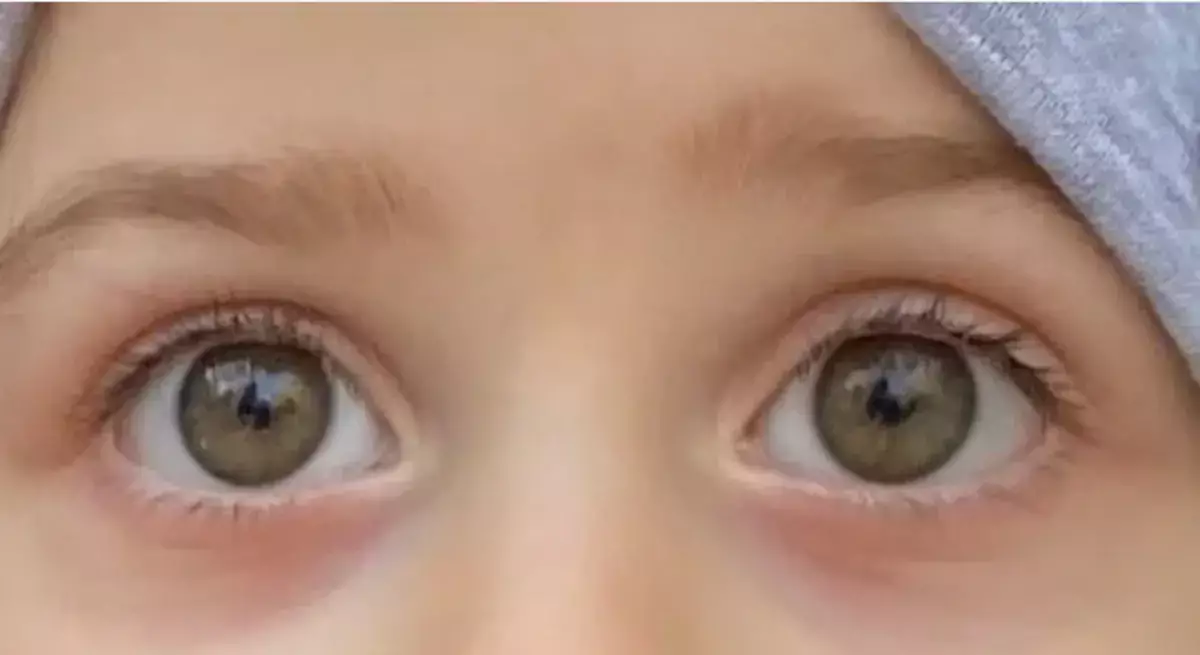 Синяки под глазами у детей: обычная усталость или тревожный сигнал? - новости на Lada.kz 25.11.2025