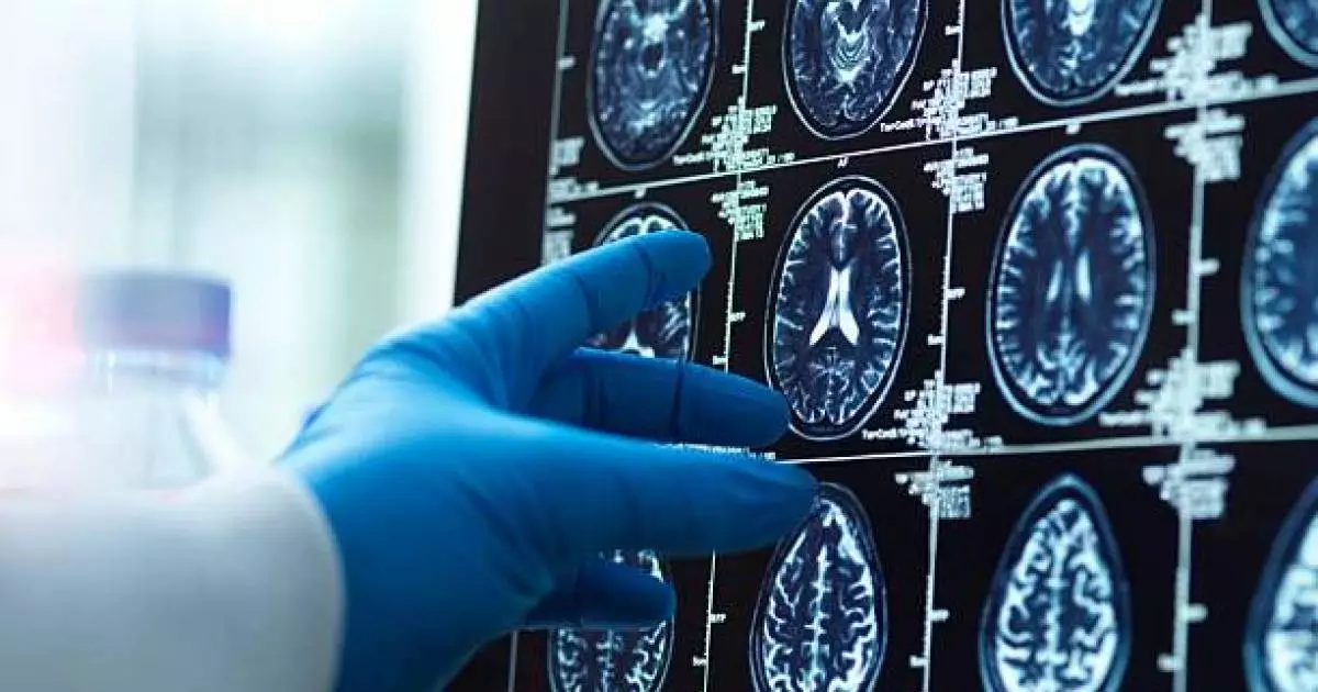  `Нағыз таңғажайып оқиға`: 18 ай ғана өмірі қалған 27 жастағы қыз ми ісігін жеңіп шыққан 