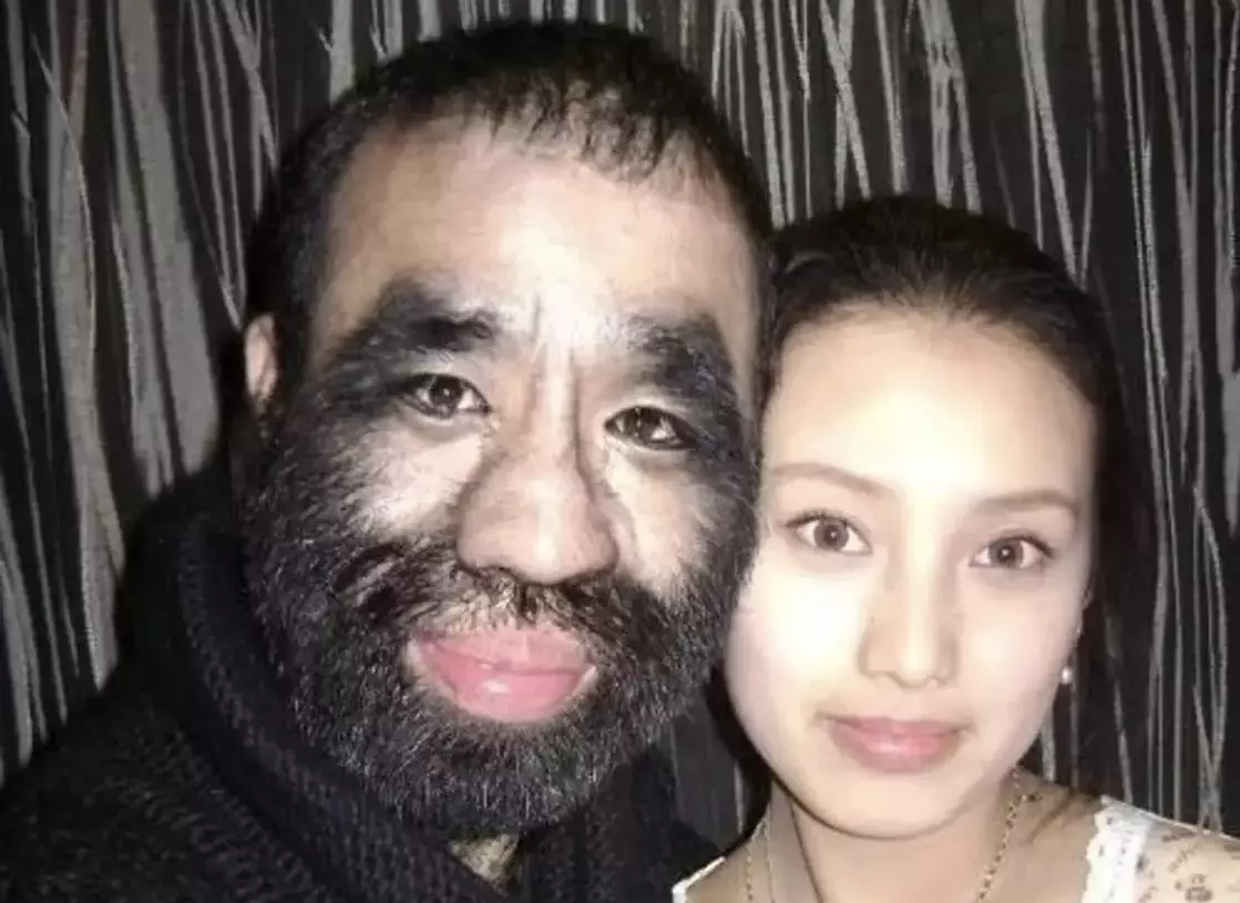 Әлемдегі ең түкті адам және оның әсерлі махаббат хикаясы