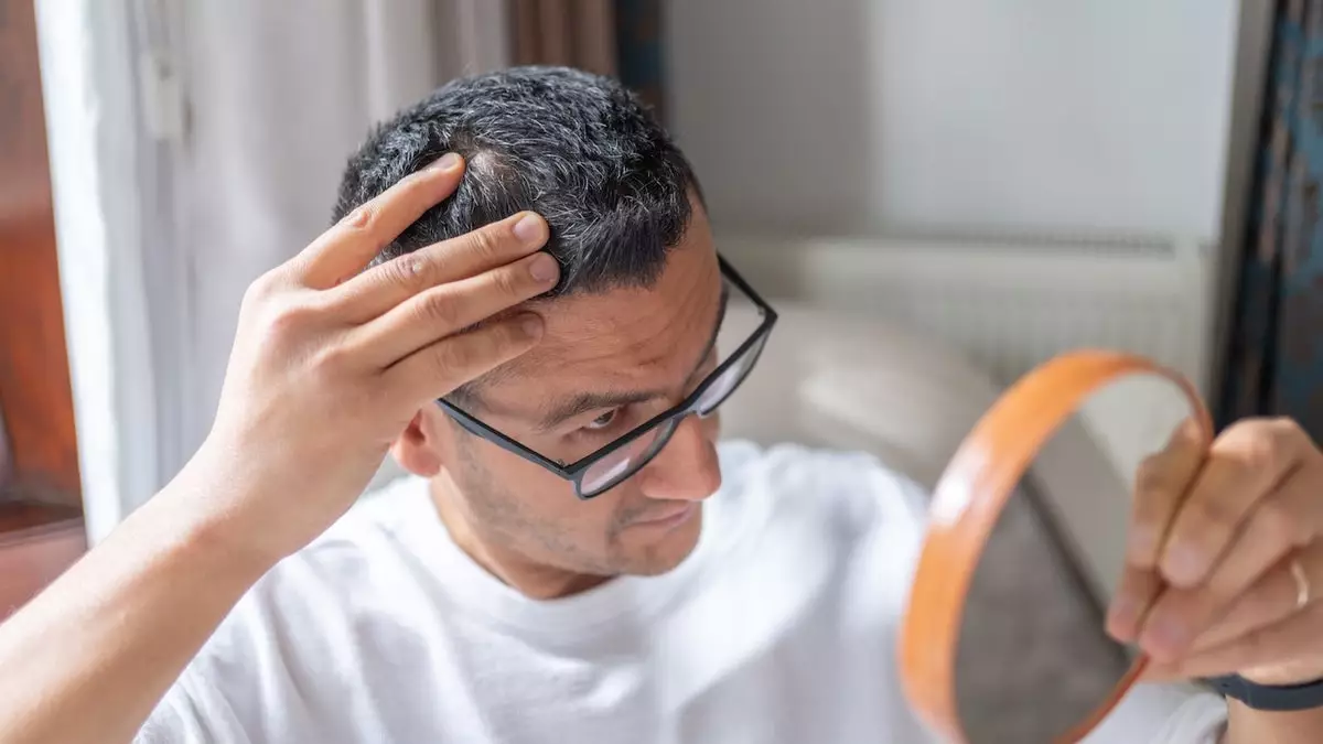 Новое средство от облысения показало значительный рост волос в крупном исследовании.