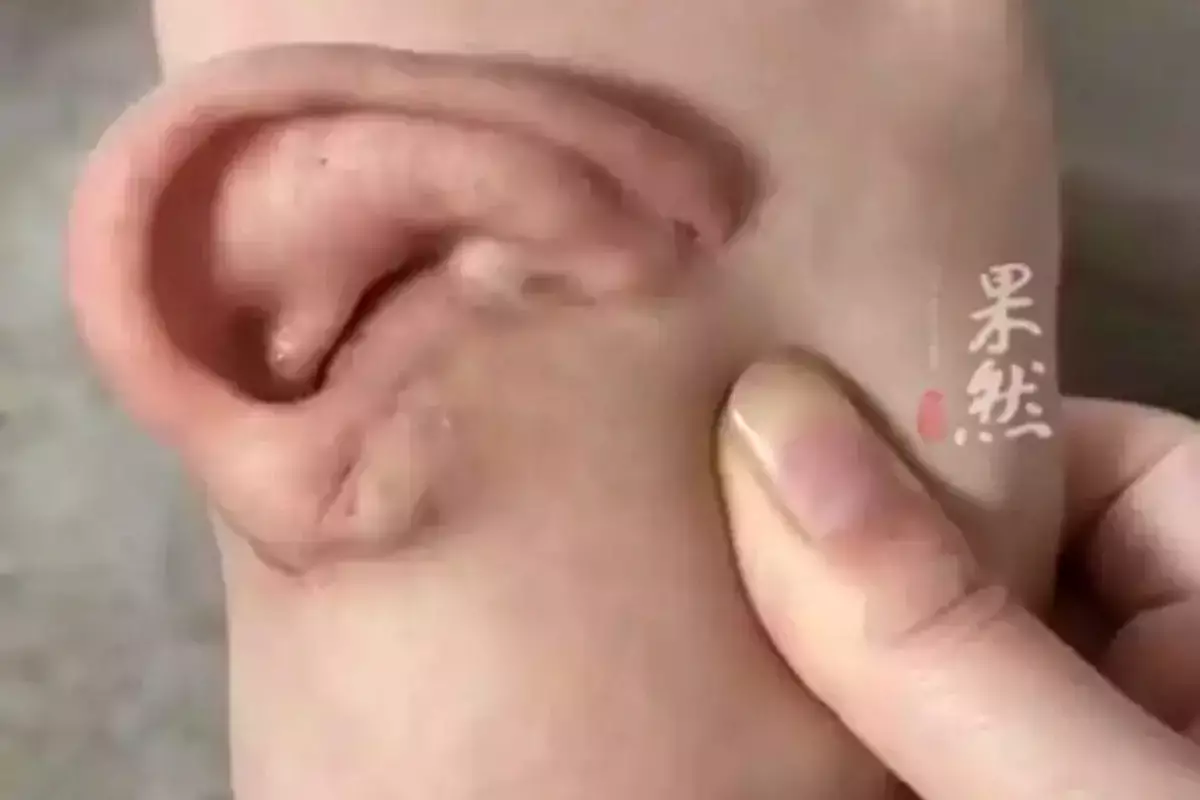 Ухо на ноге: китаянка пять месяцев носила орган на стопе ради восстановления - новости на Lada.kz 10.12.2025