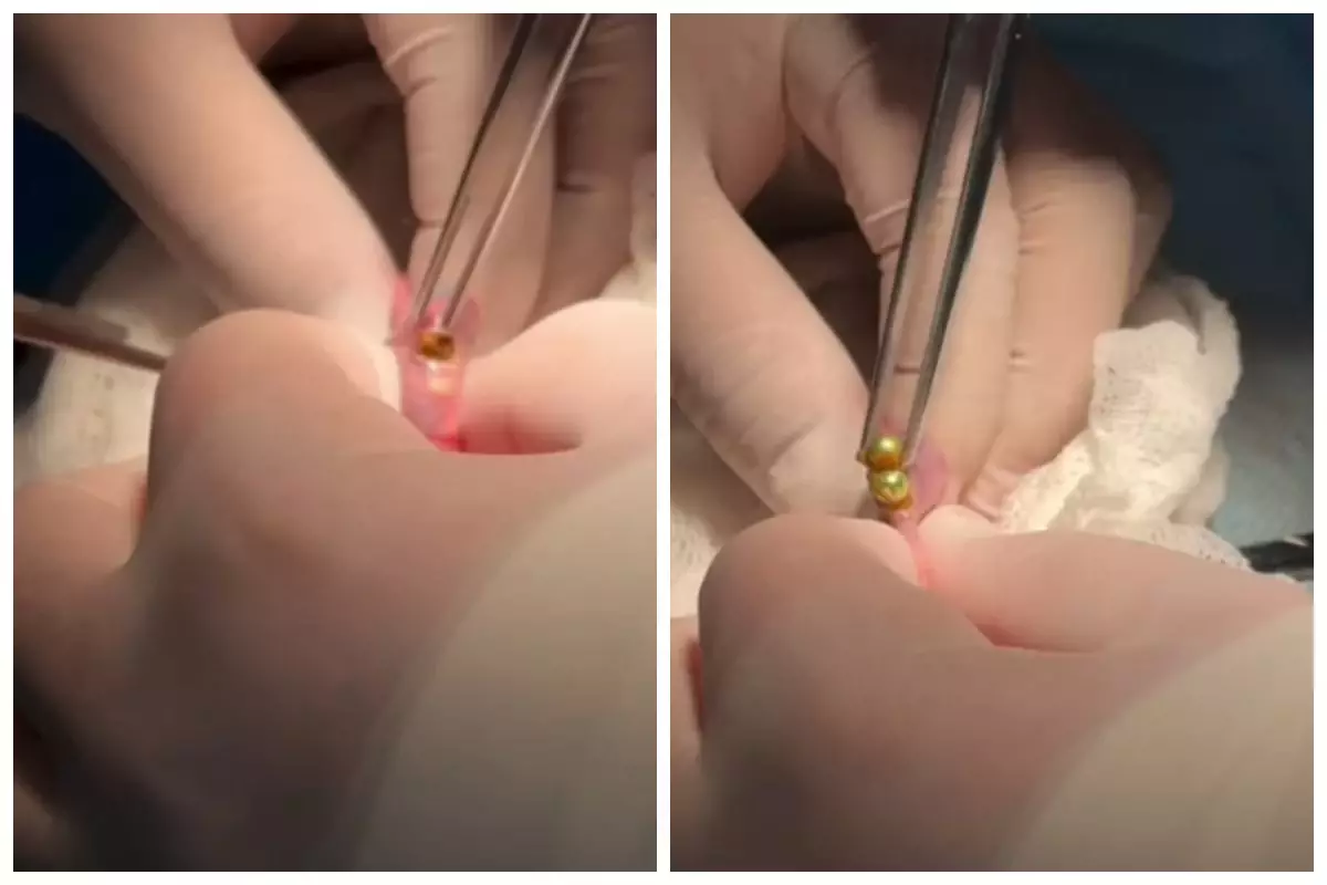 Шымкентте дәрігерлер үш жасар баланың асқазанынан 16 магнит алып шықты