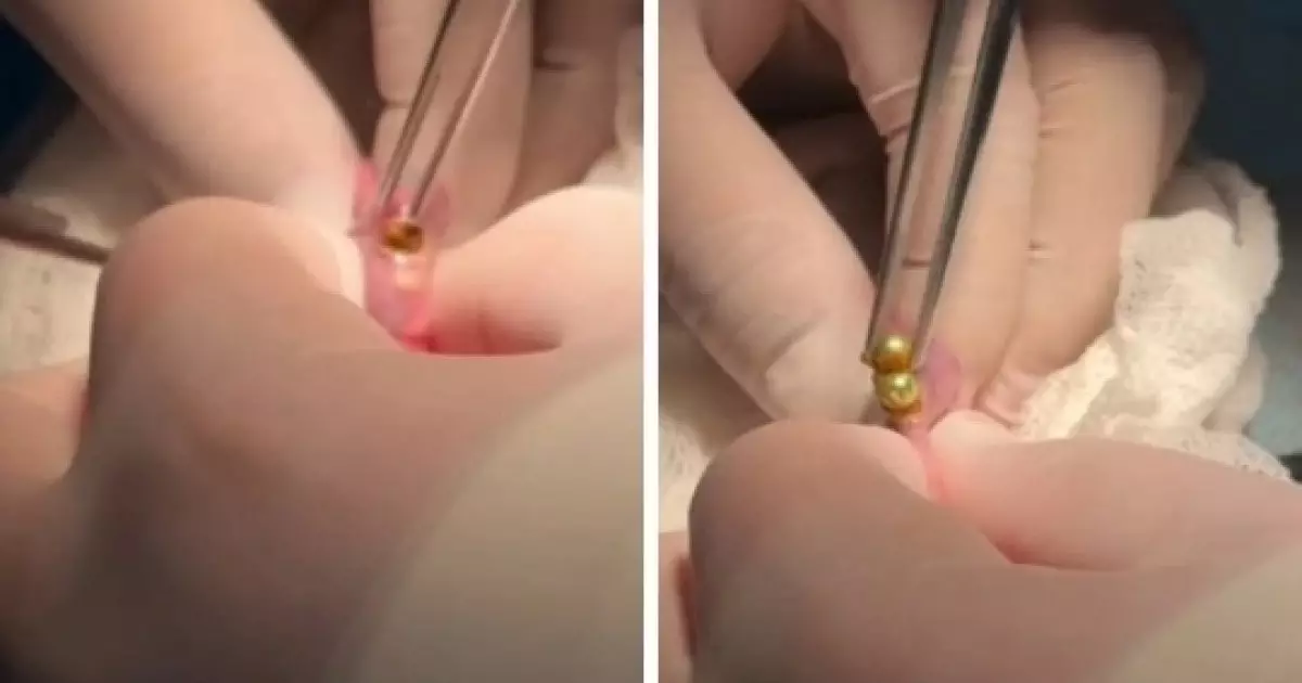  Шымкентте дәрігерлер үш жасар баланың асқазанынан 16 магнит алып шықты 