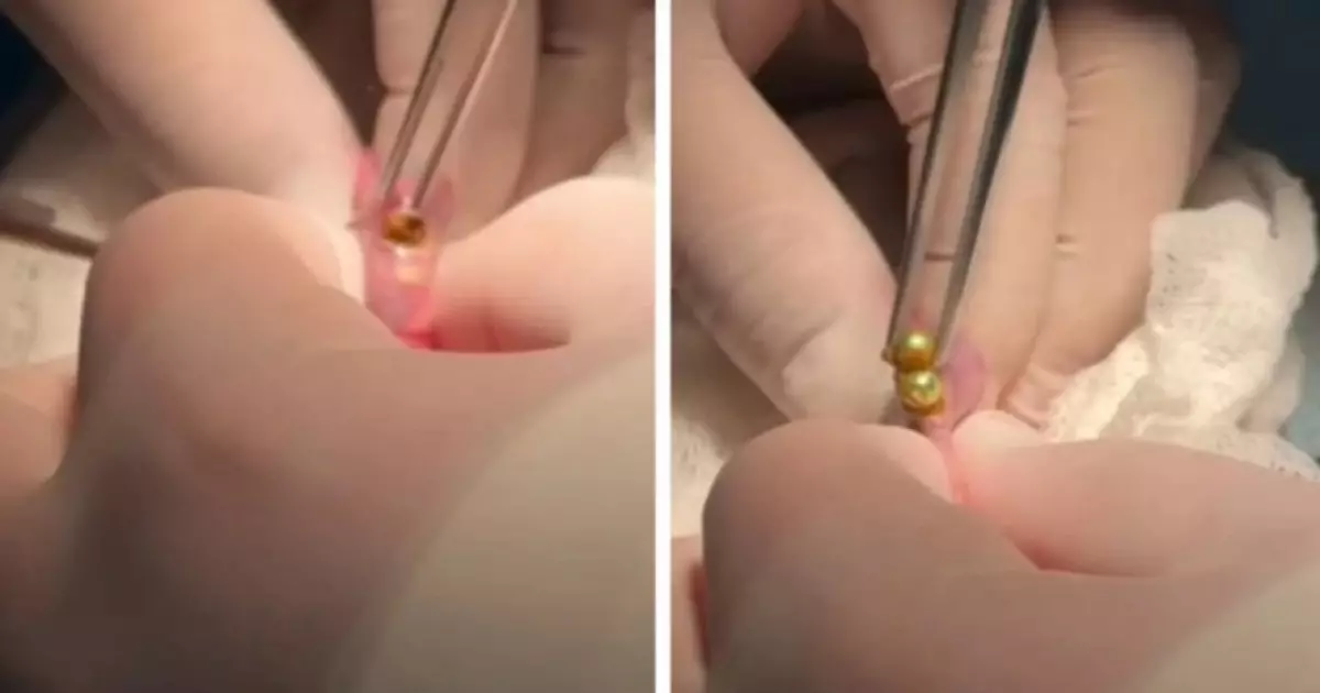  Шымкенттік дәрігерлер үш жасар баланың асқазанынан 16 магнит алып шықты 