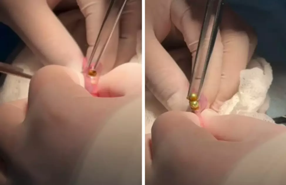 Шымкентте үш жасар бала 16 магнитті жұтып қойған: дәрігерлер шұғыл операция жасады