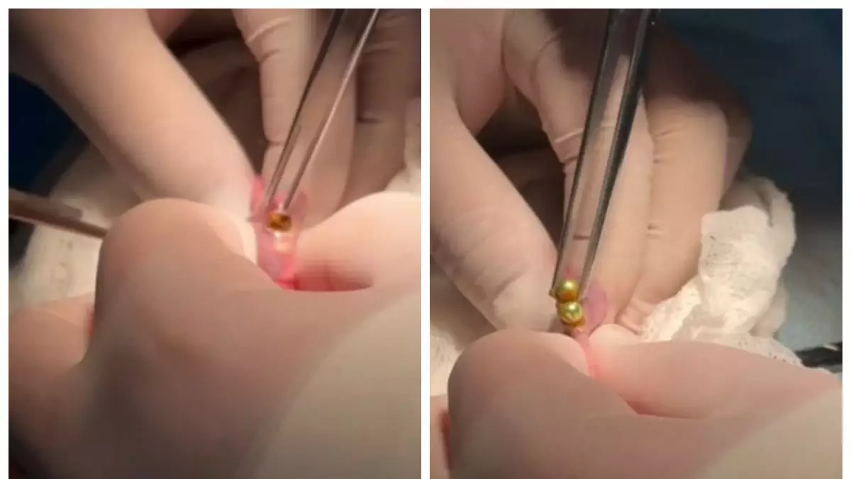 Шымкентте дәрігерлер 3 жасар баланың ішінен 16 магнит алып шықты 