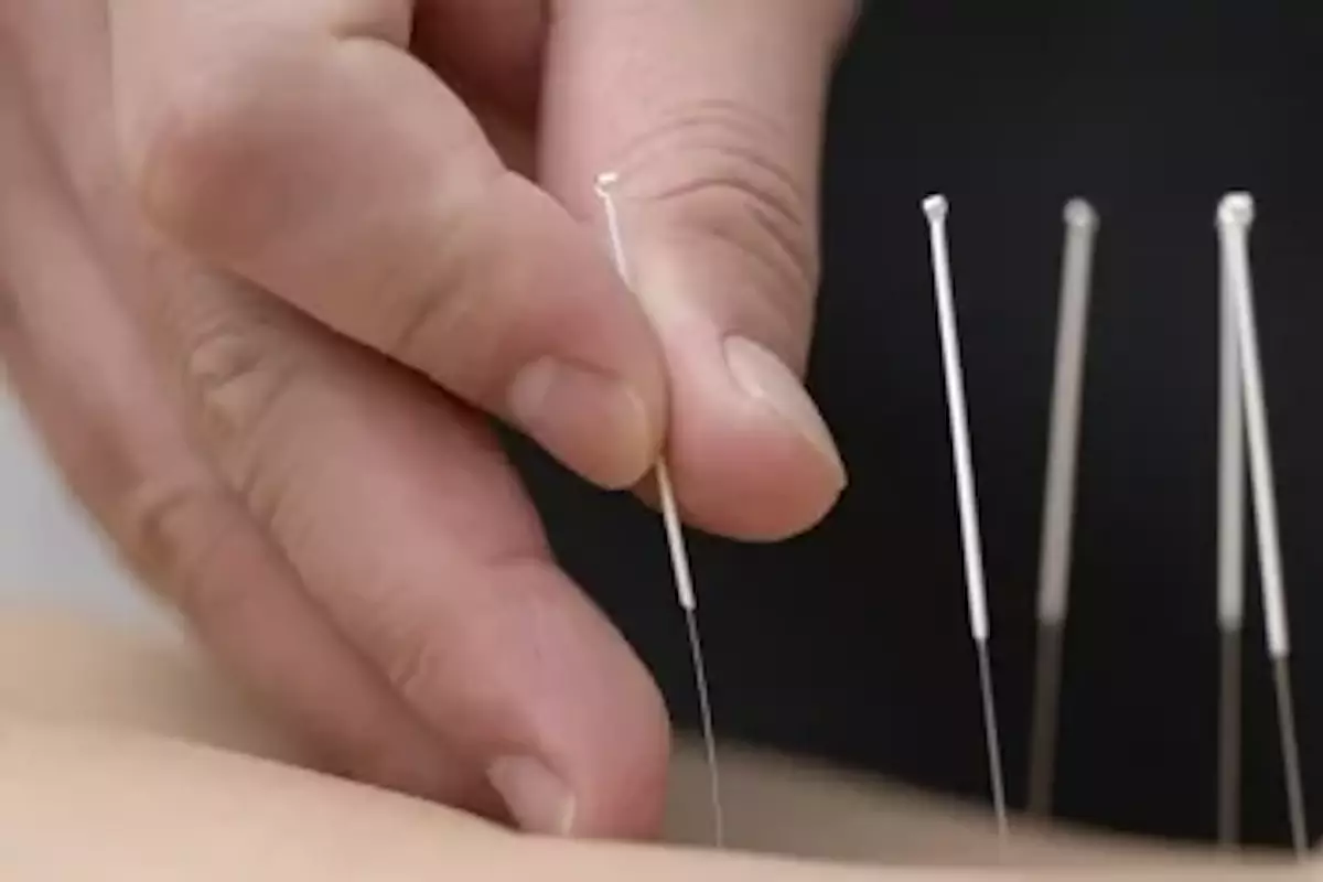 Реанимация после санатория: казахстанской пенсионерке прокололи легкое на сеансе иглоукалывания