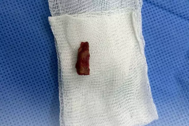 Павлодарда 10 жастағы баланың басынан 5 жыл бұрын кірген ағаш бұтағының қиындысы алынды