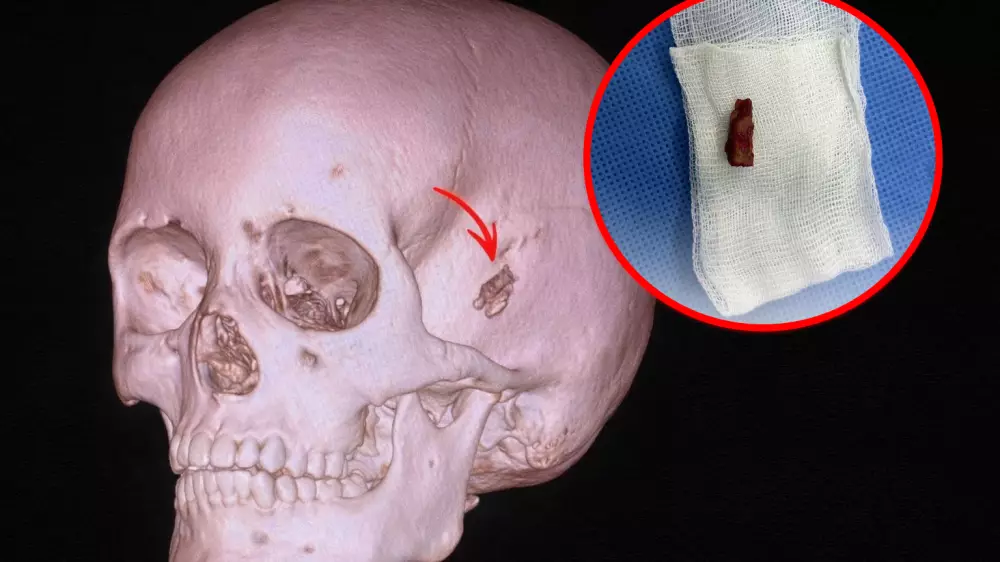 10-летний казахстанец 5 лет жил с куском ветки в голове