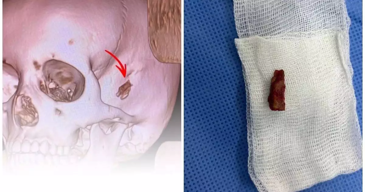  10 жастағы баланың басынан 5 жыл бұрын кірген бұтақ алынды 