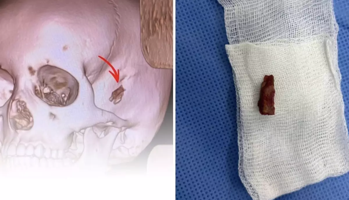 10 жастағы баланың басынан 5 жыл бұрын кіріп кеткен бұтақтың бір бөлігі алынды