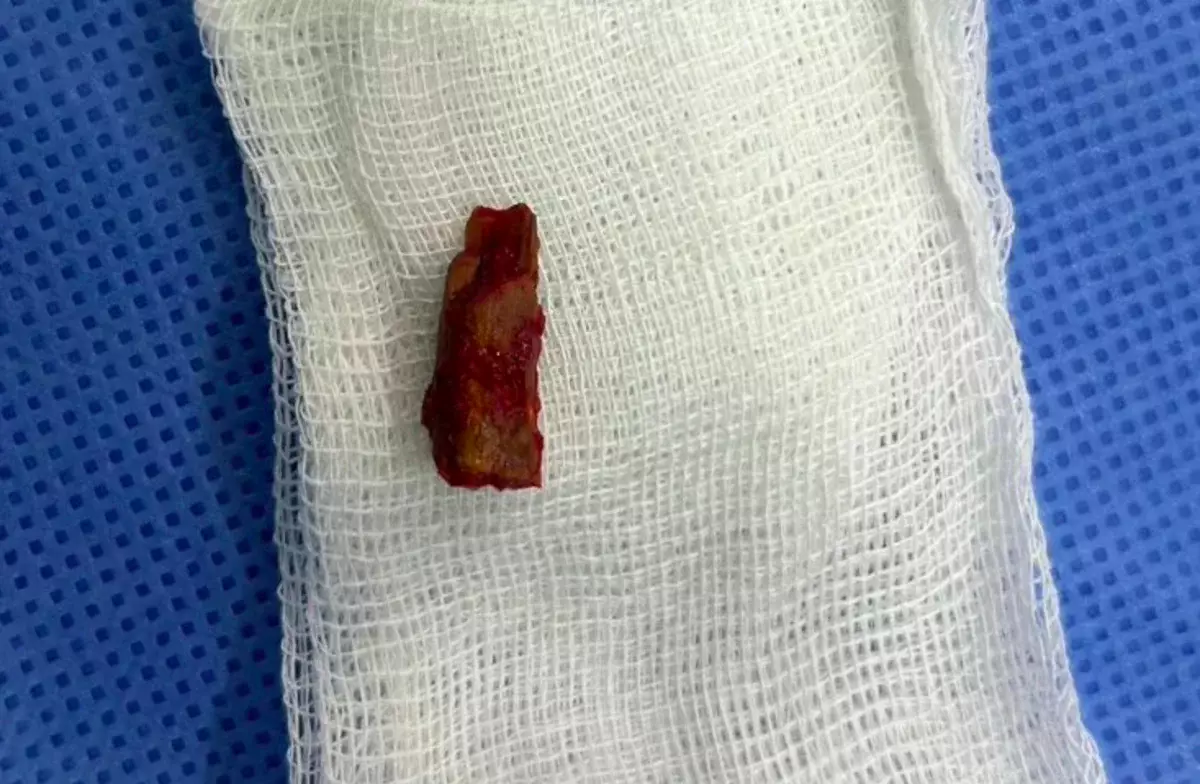 Кусок ветки извлекли из виска ребенка в Павлодаре