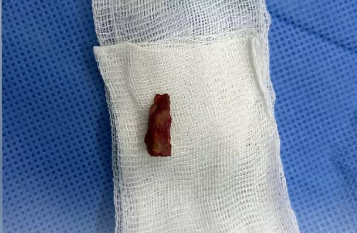 Мальчик пять лет прожил с веткой под кожей в Павлодаре