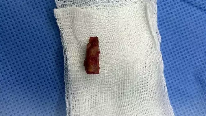 Дәрігерлер баланың басынан 5 жыл бұрын қадалған бұтақты алып шықты