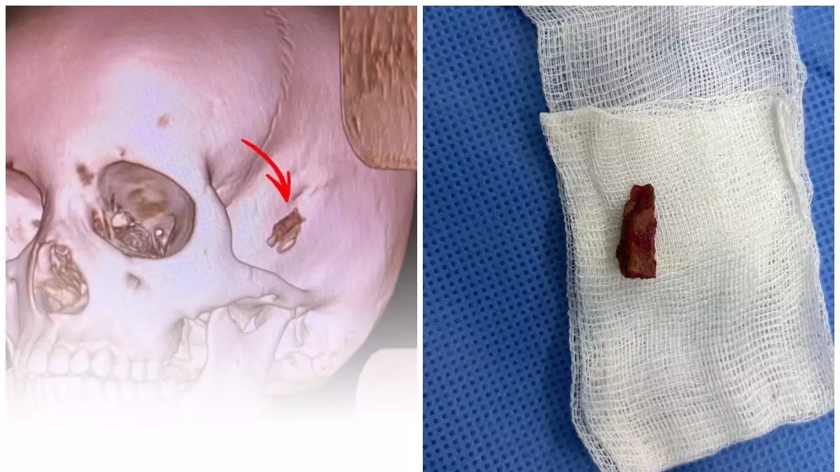 "5 жыл бұрын кіріп кеткен": Дәрігерлер 10 жастағы баланың басынан бұтақтың бөлігін алды 