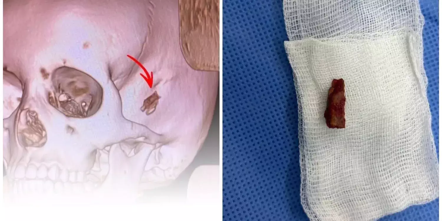 Павлодарда 10 жастағы баланың басынан бес жыл бұрын кіріп кеткен бұтақтың бір бөлігі алынды