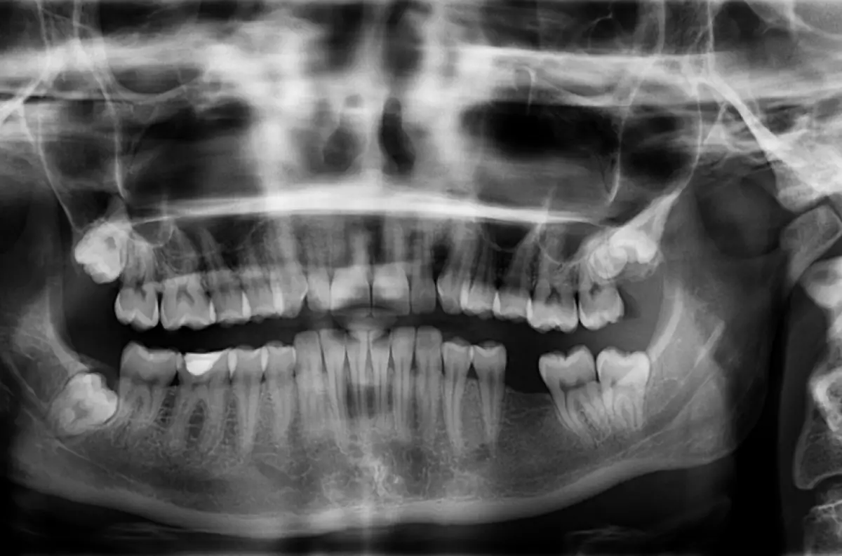 Стоматологи обнаружили пулю в челюсти пациентки из Караганды