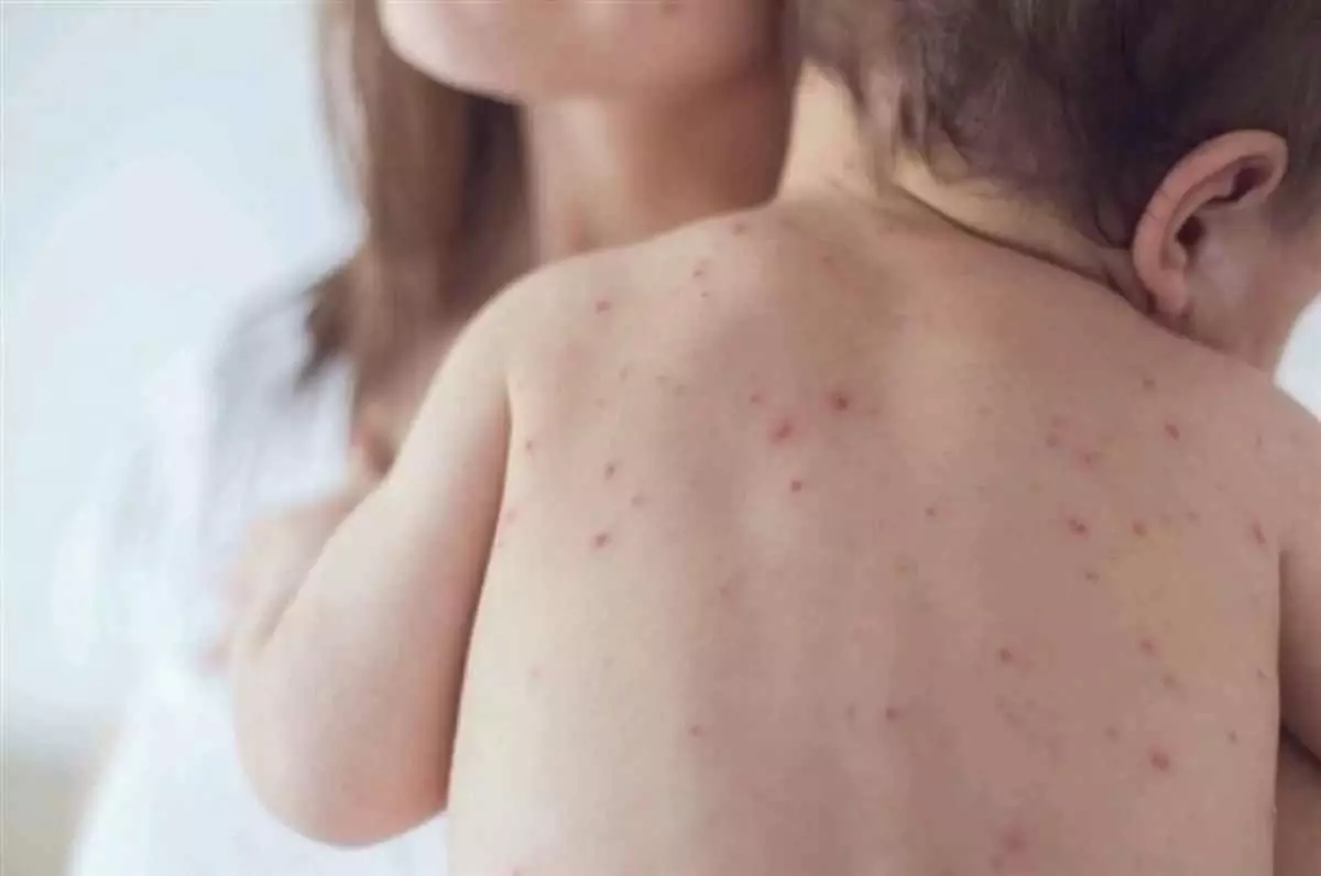 "Күн сайын шамамен 25 жағдай": Қазақстанда қызылша ауруы өршіді